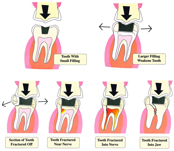 Cameron_Amalgam_Fillings