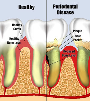 Romie Lane Dental Group Gum Disease 1