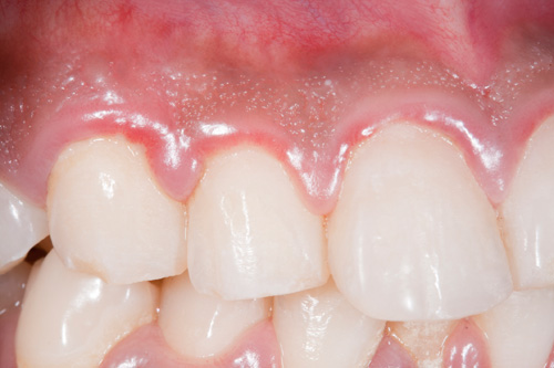Romie Lane Dental Group Gum Disease Mitch